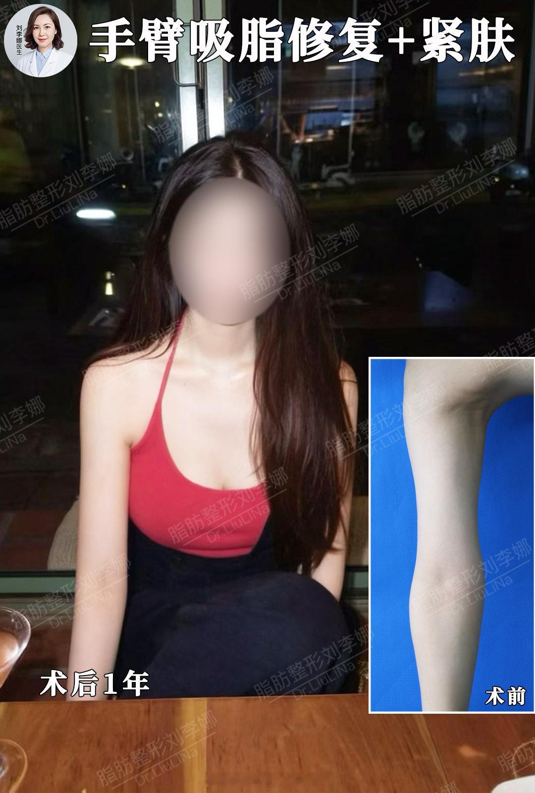 脂肪整形刘李娜 手臂吸脂 手臂吸脂失败修复 小姐姐之前外院做过一次手臂吸脂，但是