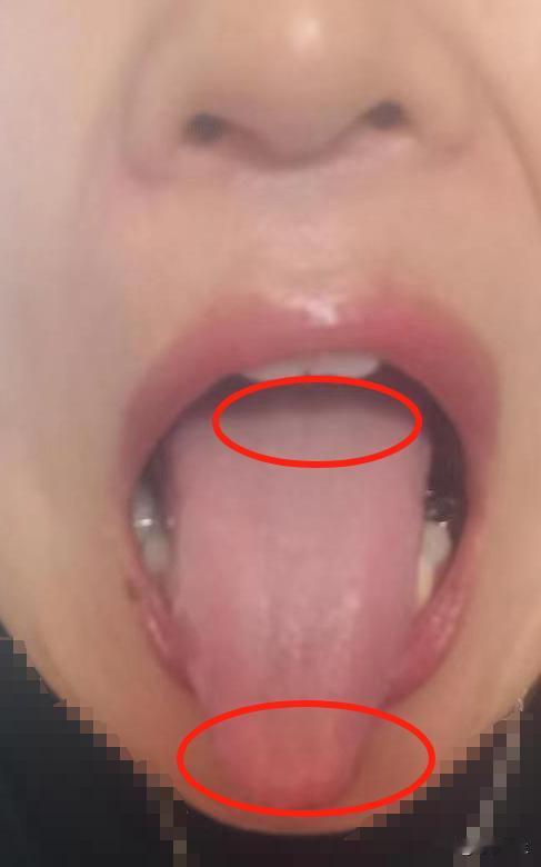 这位粉丝朋友，现在的情况可不能去补啊，首要任务还是疏，要不然就是补方用再久，也徒