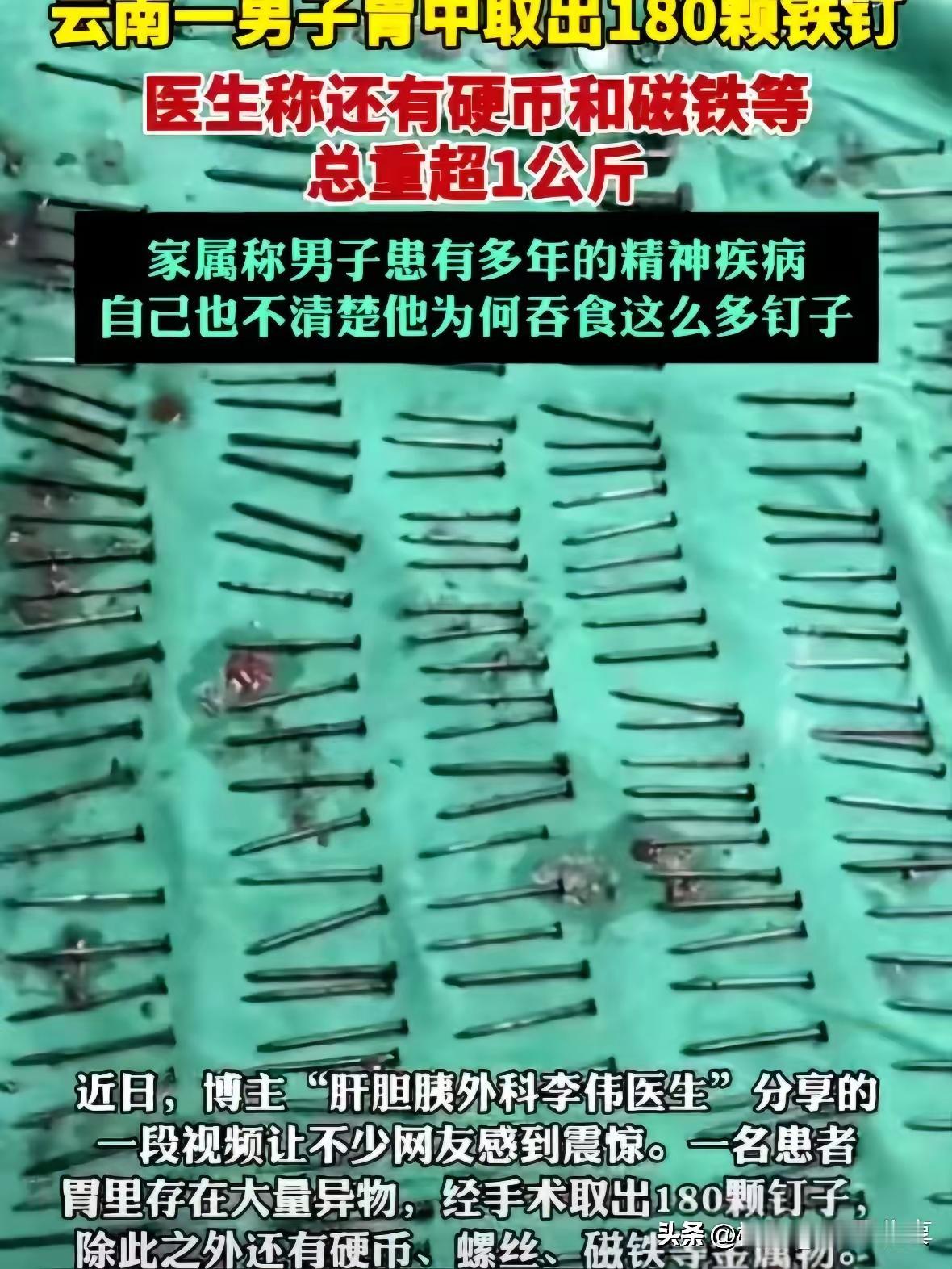 昆明一男子近年呑铁钉约1公斤，幸而医院抢救生命无碍

近日，一名36岁的男子因腹