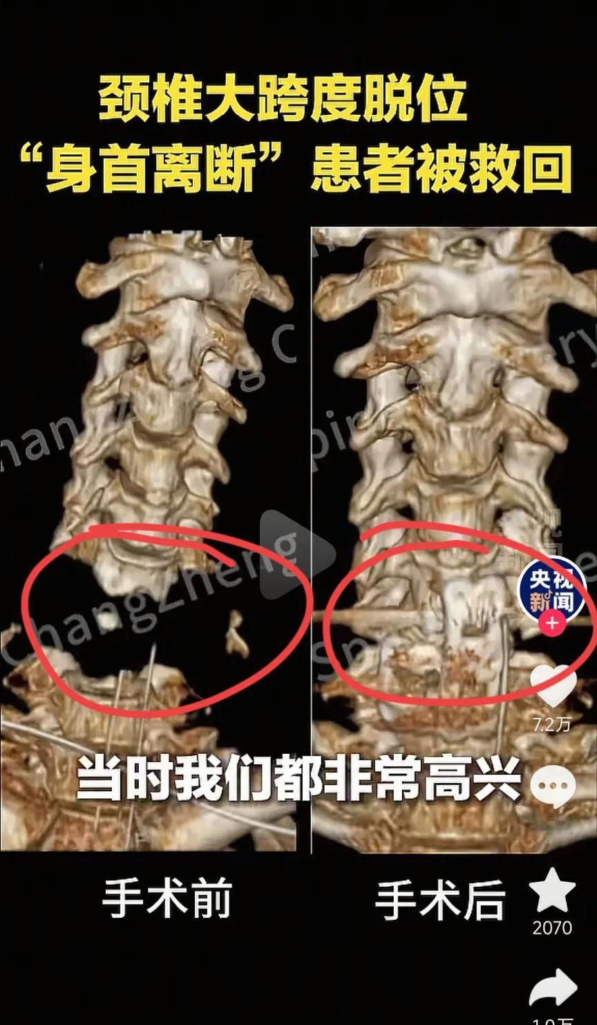 “身首离断”还能救回来，惊到我了！颈椎大跨度脱位，被上海长征医院给救回来了！
 
