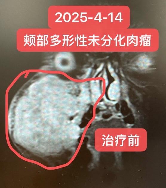 头颈部肿瘤-肉瘤的综合治疗。患者 男 38岁，2025-3-17于上海...