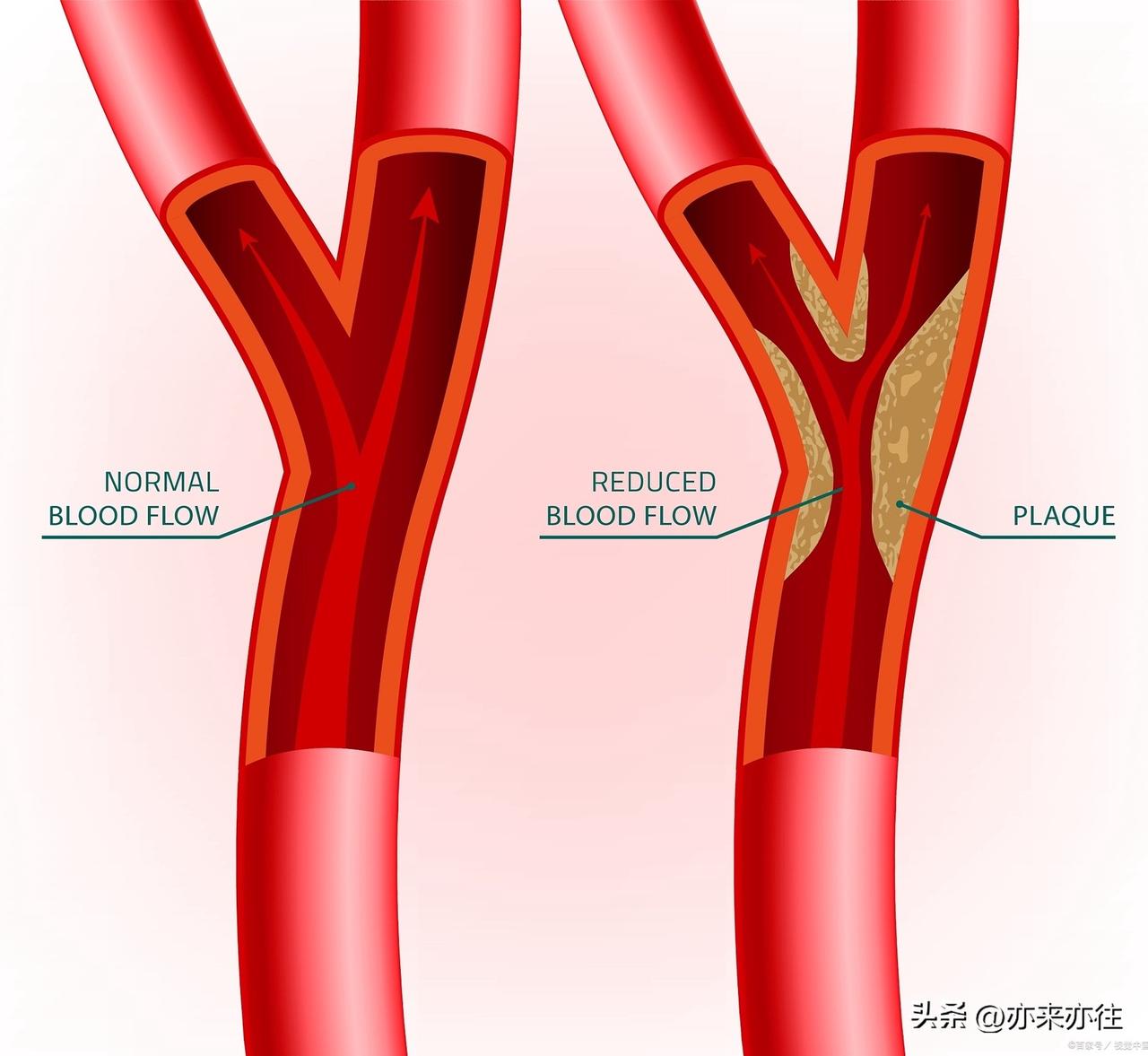 体检时查出颈动脉斑块，医生建议放支架？58岁的张阿姨却用中医调理避开了手术——坚
