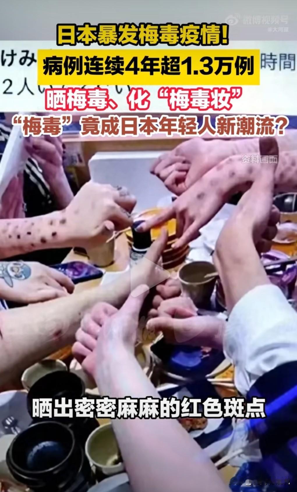 日本的梅毒患者也太多了吧，每年竟然有这么多人得梅毒，真的是太乱了。
日本爆发梅毒