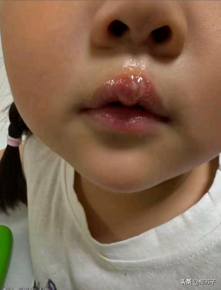 幼师拿热熔枪烫伤小女孩的嘴唇，都起大泡了。小女孩有什错受到如此惩罚。这个幼儿园老