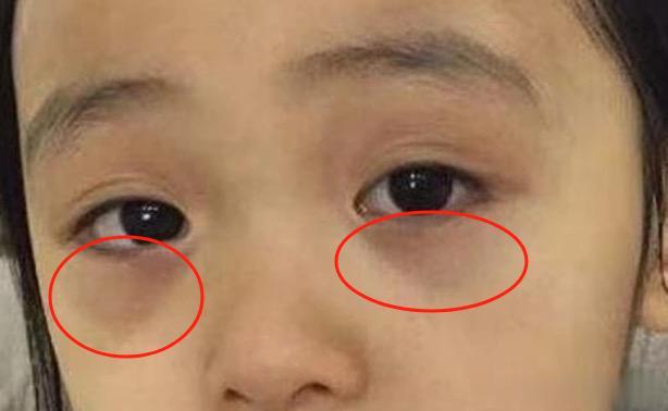 很多家长误把孩子“鼻炎”当“感冒”，治疗方法不同，别搞混了！
 
孩子鼻塞、流鼻