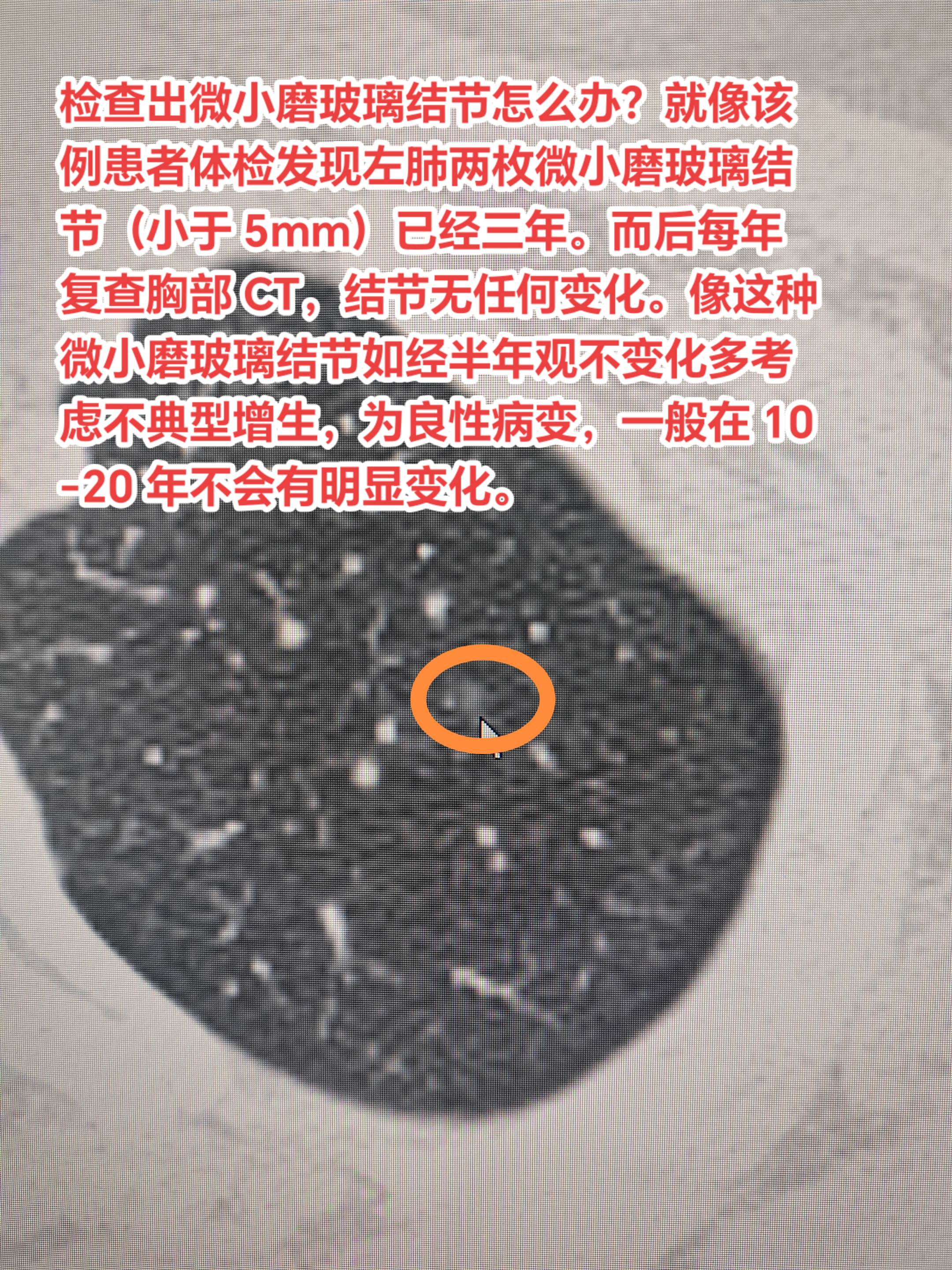 发现微小磨玻璃结节如何处理🤔？检查出微小磨玻璃结节怎么办？ 就像该例...