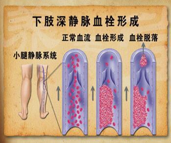 #经济舱 血栓# 【什么是经济舱综合征？如何预防呢？】经济舱综合征是指由于长时间