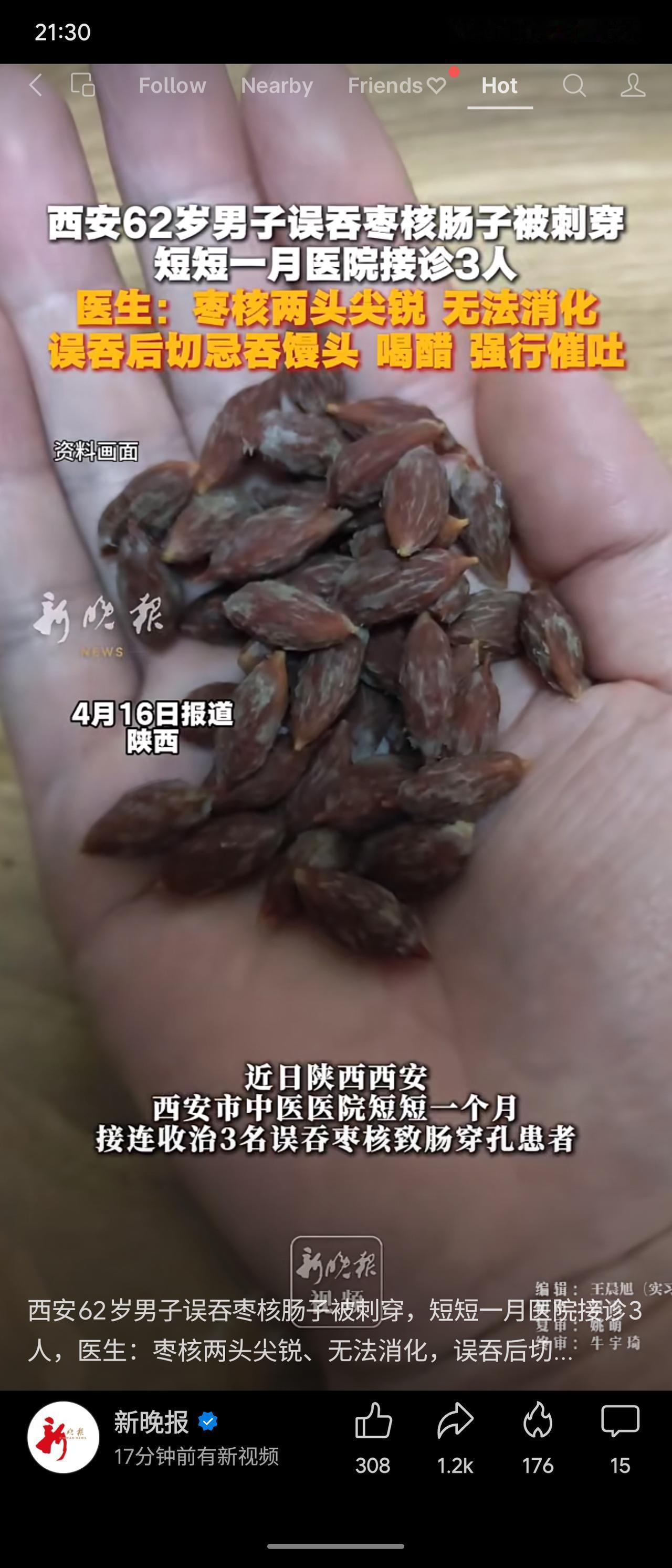 西安62岁男子误吞枣核致肠穿孔，引发急性腹膜炎，经微创手术康复。短短一月该院接诊