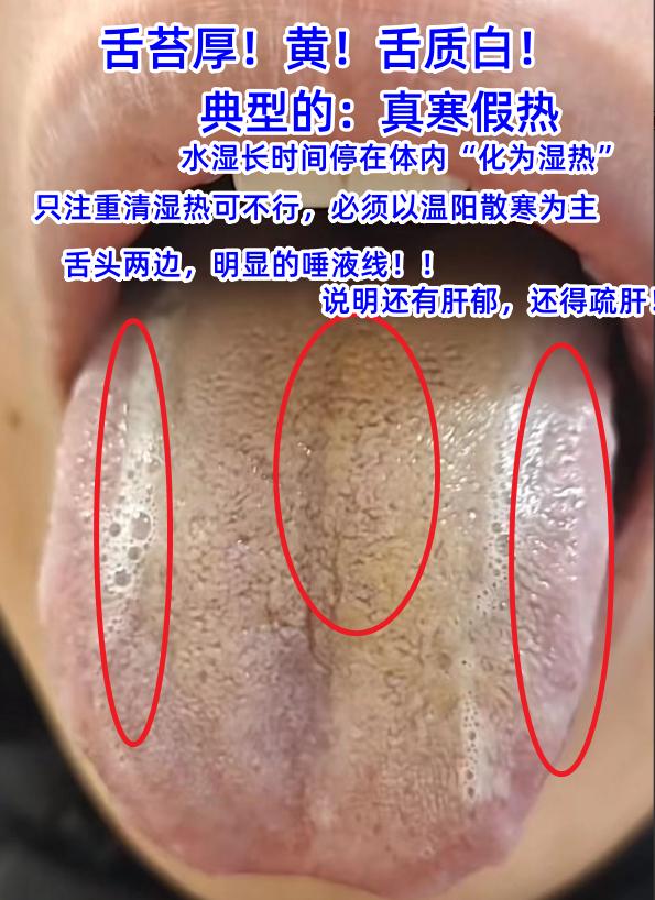 今日舌诊案例分析：真寒假热，肝郁气滞，肝肾阴虚，气滞血瘀[谢谢][谢谢][谢谢]