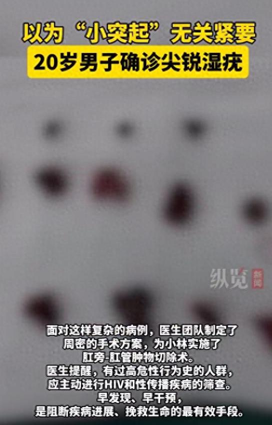 福建漳州，一20岁小伙，突然发现肛周长出很多“肉疙瘩”，不疼不痒，被确诊是HPV