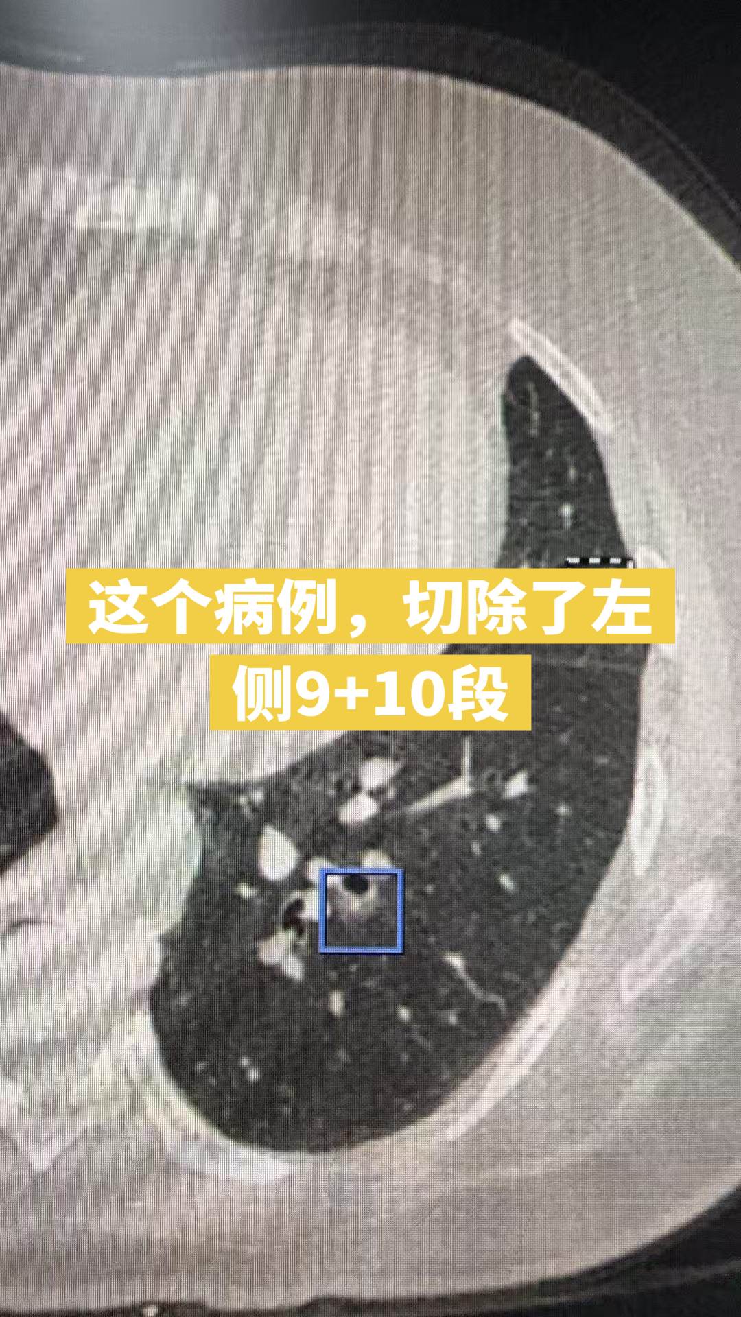 复杂肺段保肺……这例至少微浸润，切缘远远＞20mm，花了心思做术前准备...