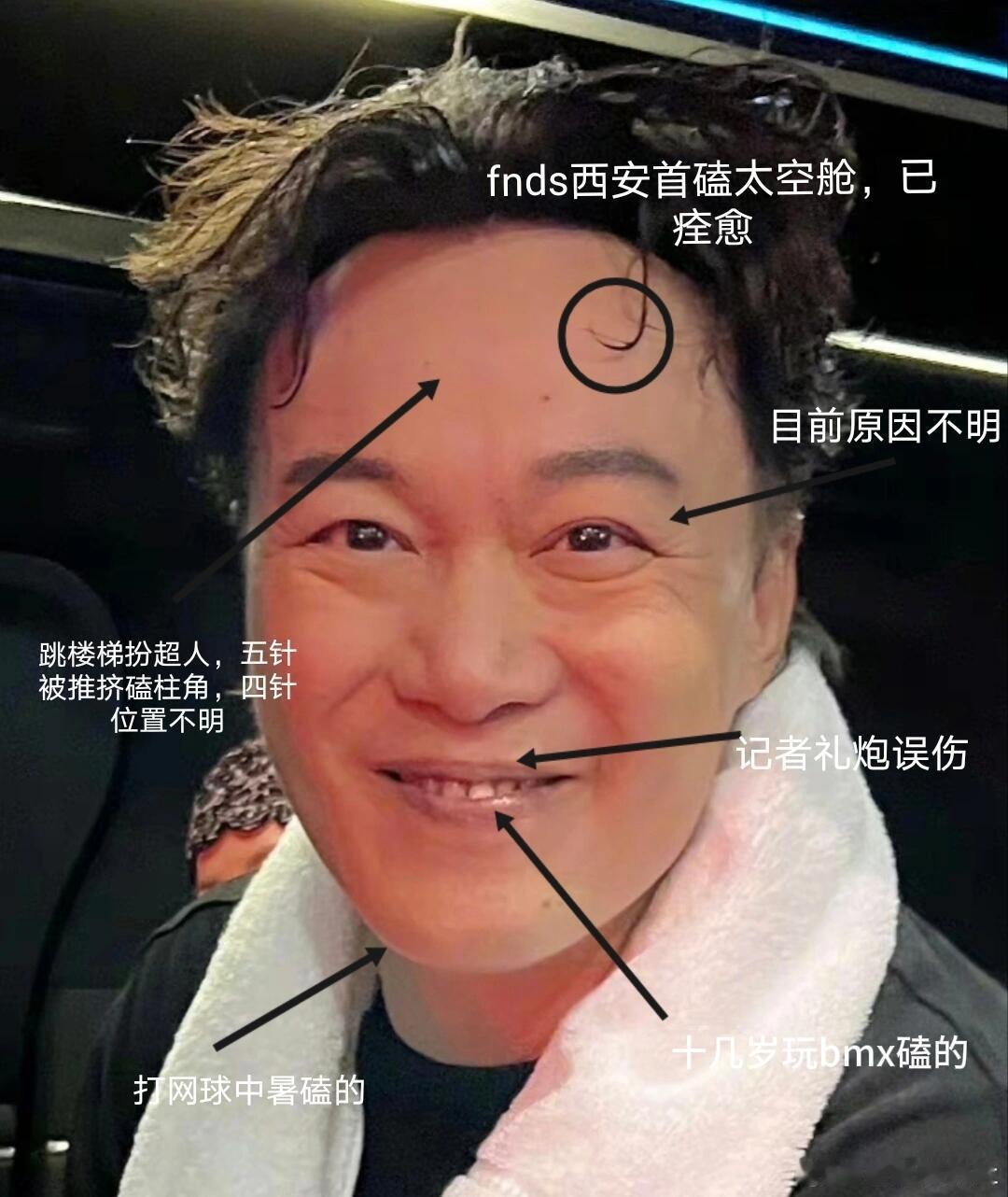 陈奕迅受伤盘点，这张脸安全到五十岁没有破相真是不容易 