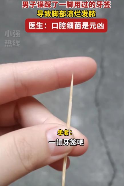 “悲剧还是发生了！”广东一男子不小心踩中了自己用过的牙签，眼看伤口就一个小洞，也