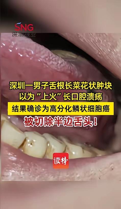 “悲剧还是发生了！”近日，广东深圳，一男子舌根上长了些菜花状的凸起，他以为是上火