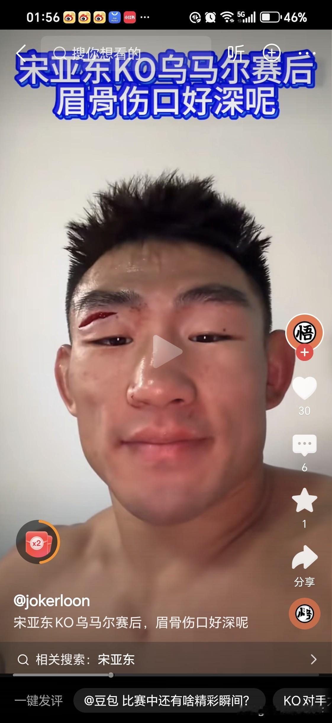 宋亚东KO乌马尔（俄罗斯名将，小鹰的兄弟）

宋亚东的伤口，让人感觉搏击运动员的