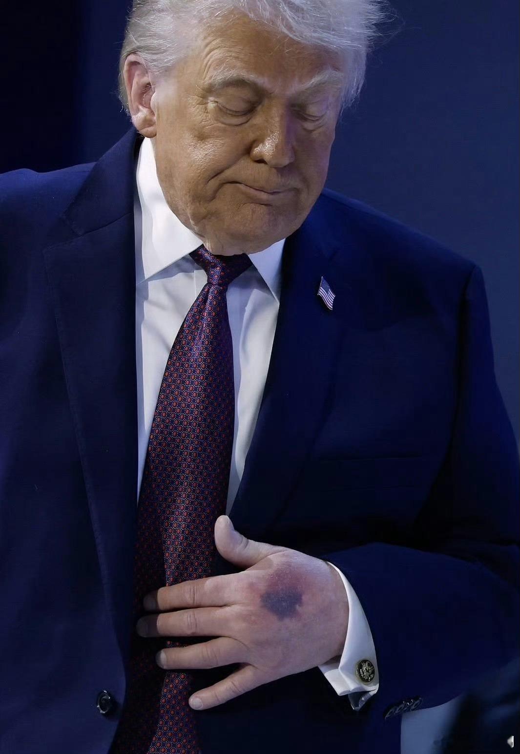 《川总手上的乌青块》川总手上的乌青块，引来众多网友的关心，最体贴的一个关心是：川