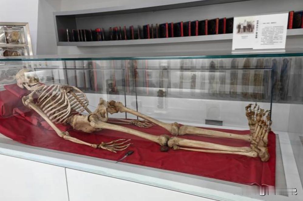 2005年，湖南湘雅医学院的标本室里，放着中国“第一女巨人”曾金莲的遗体，白布包