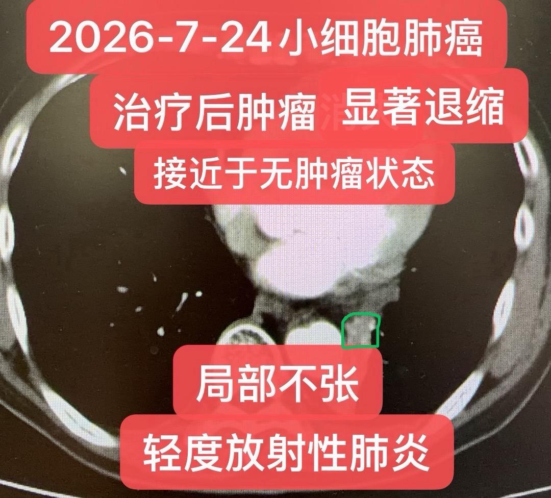小细胞肺癌挽救治疗：病情起伏。小细胞肺癌挽救治疗个案分享（非普适性方案...