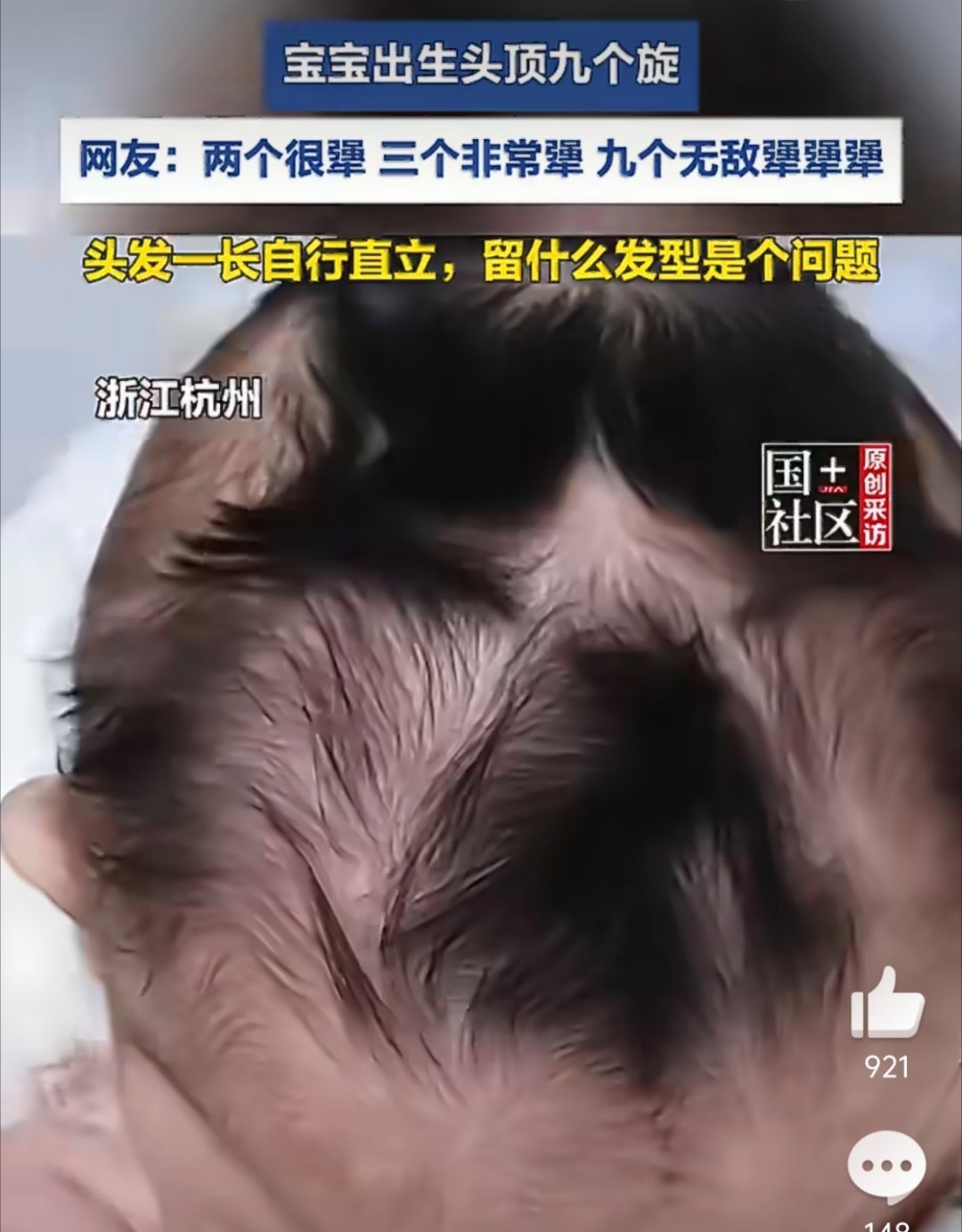 医师回应宝宝头顶九个旋娃以后发型要难坏托尼