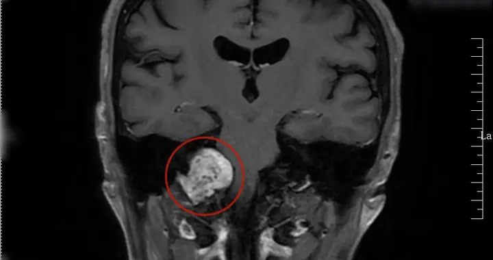 颅内肿瘤“蛰伏”10余年长到网球大小 武大人民医院多学科联手揪出精神障碍背后的“隐形炸弹”