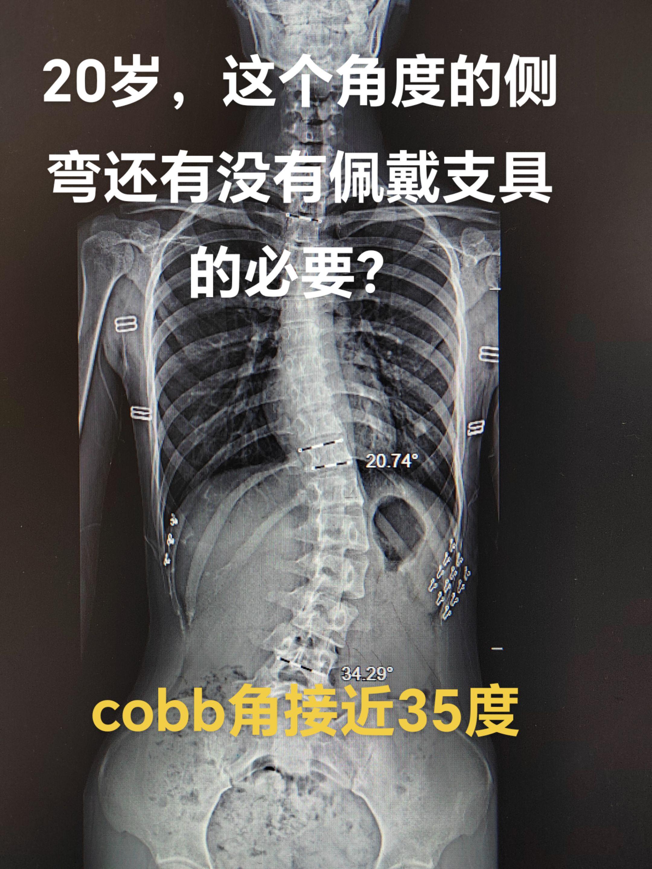 成人后的脊柱侧弯治疗。搜索下百度，，豆包，许多博主或文章告诉你这种情况...