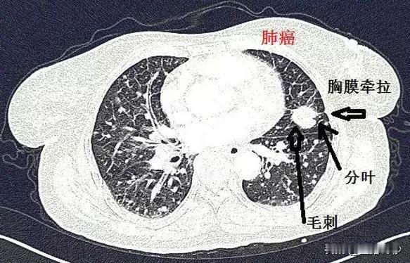 治疗肺结节常用的7个中成药，建议收藏

肺结节是肺部常见的一种病变，多数为良性，