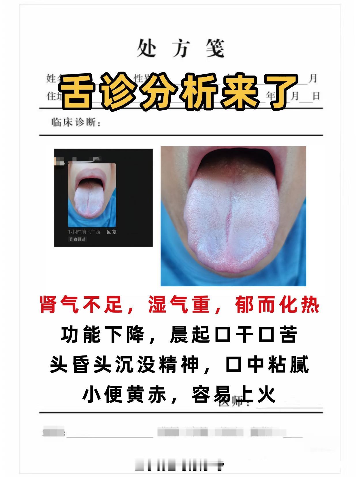 舌诊分析来了！
今天周三我值班！继续给大家看600位患者的舌象！一个不漏统统看完