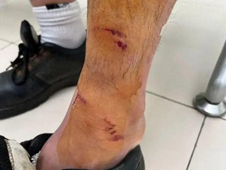 宁波发生“一犬伤多人”事件，造成3人受伤，医生提醒：被抓咬后切勿心存侥幸。
这篇