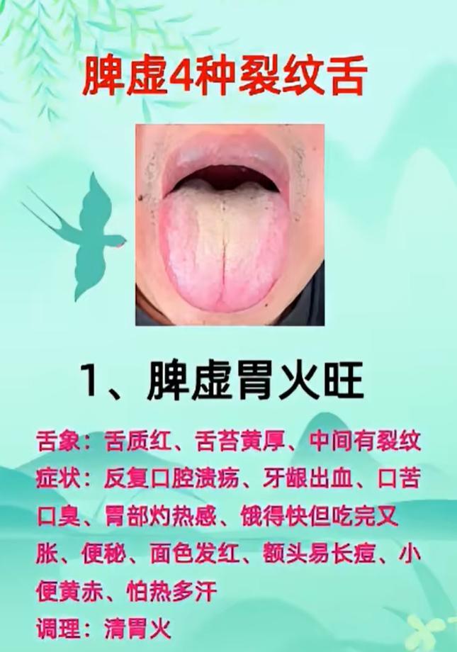 同样是裂纹舌，调理天差地别！4 种脾虚舌象一次看懂