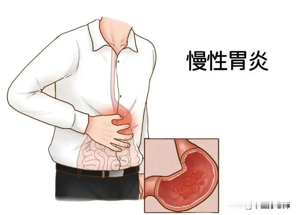 张某，男，48岁，患慢性胃炎多年（胃镜检查，胃窦处糜烂性胃炎，反流性食道炎），这