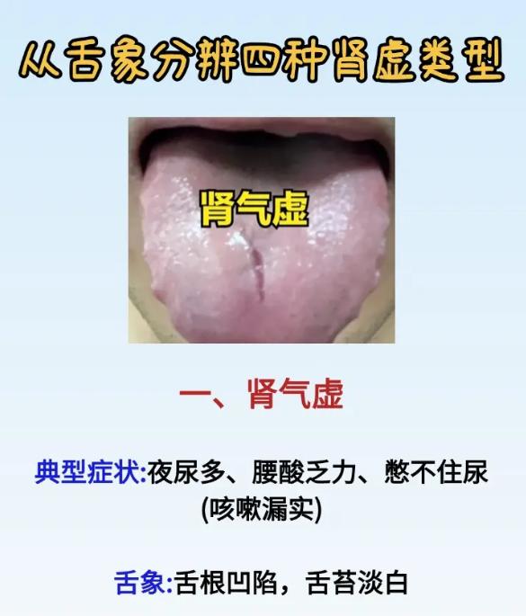 从舌象分辨四种肾气亏虚类型