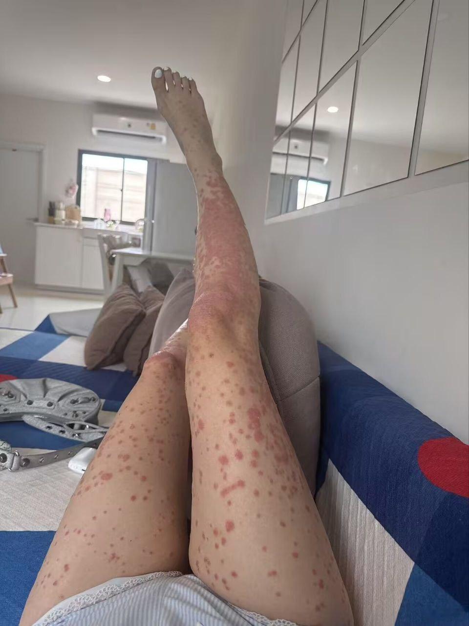 女朋友说被蚊子叮了，好难受[生病][生病]  ​​​