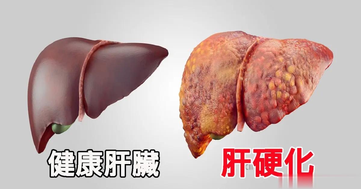 关于肝硬化的3件事，你一定要知道一、哪些人容易得肝硬化1. 病毒性肝炎，如乙肝、