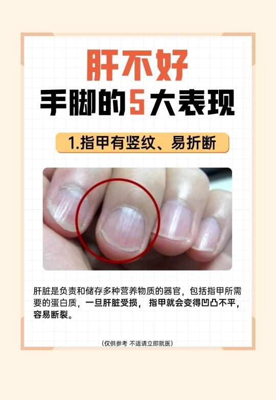肝不好，手脚的5大表现！