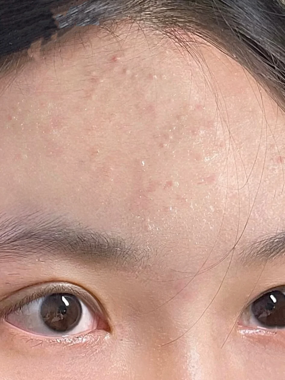 痘痘总算下去了！