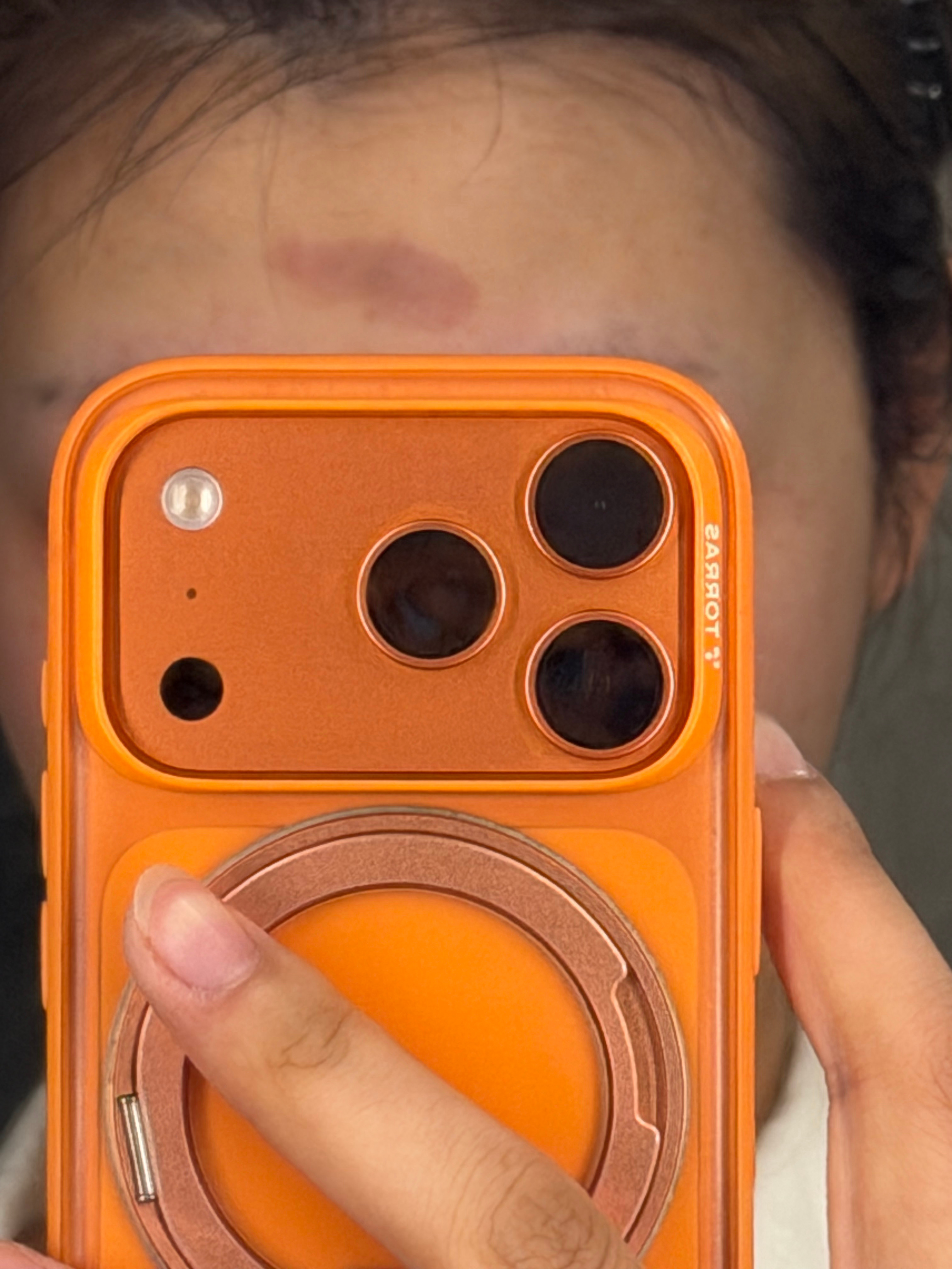 张子萱额头被卷发棒烫伤卷发棒烫脸上别的不说真的丑，而且留印时间很长，我之前心血来