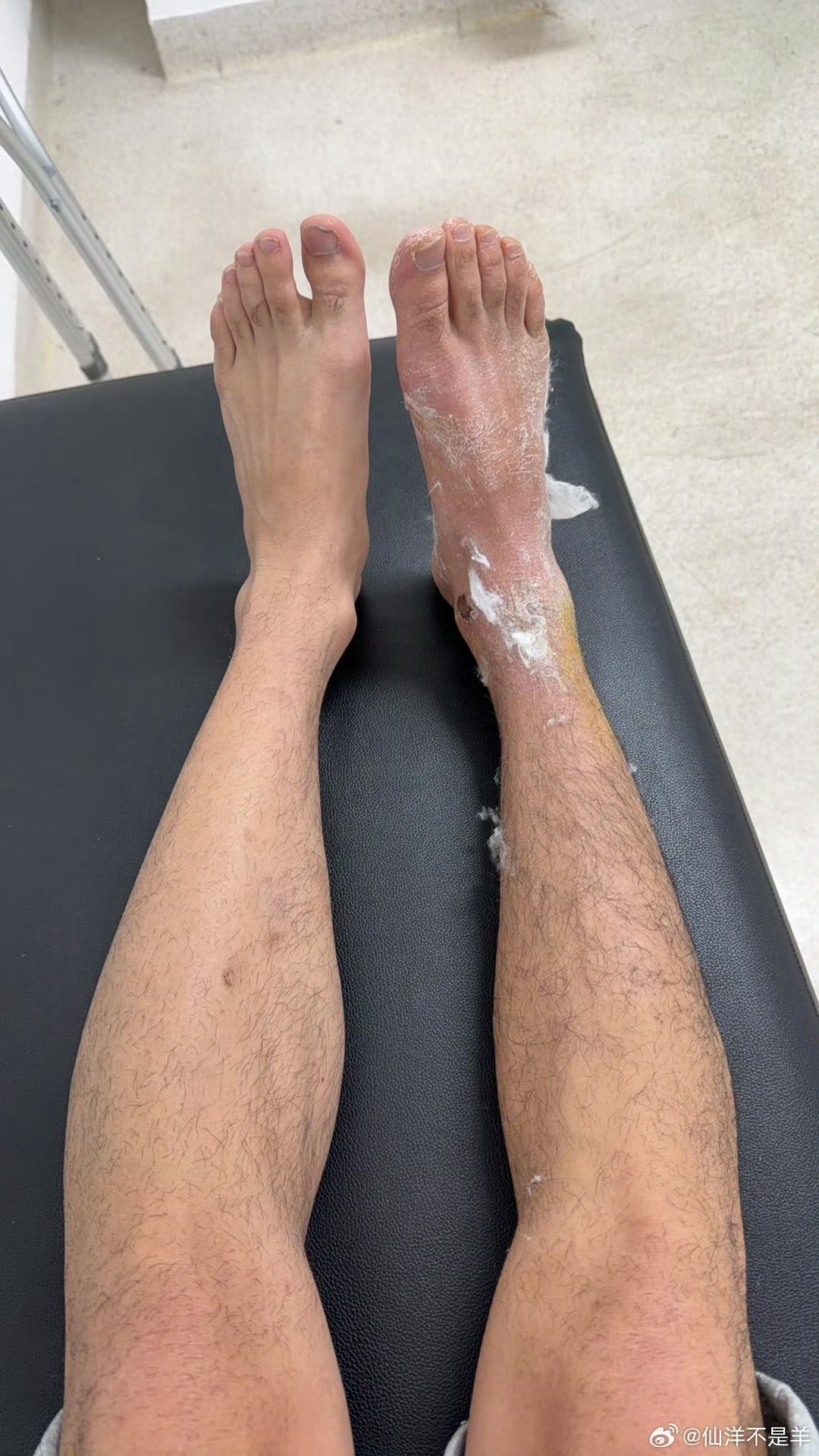 仙洋拆石膏了，腿瘦成啥了。 