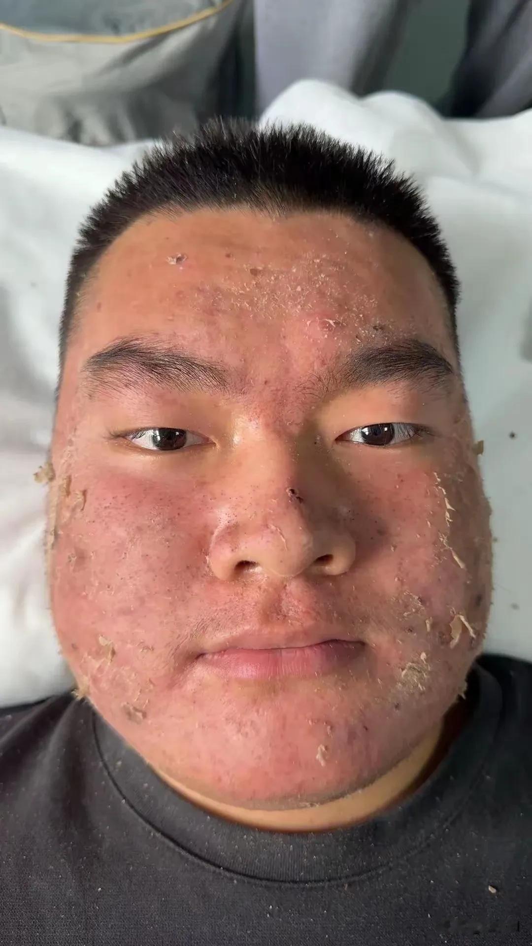 表弟在工地干了一个星期就这样了，如果谁家孩子不愿意上学请让他看看～[可怜][可怜
