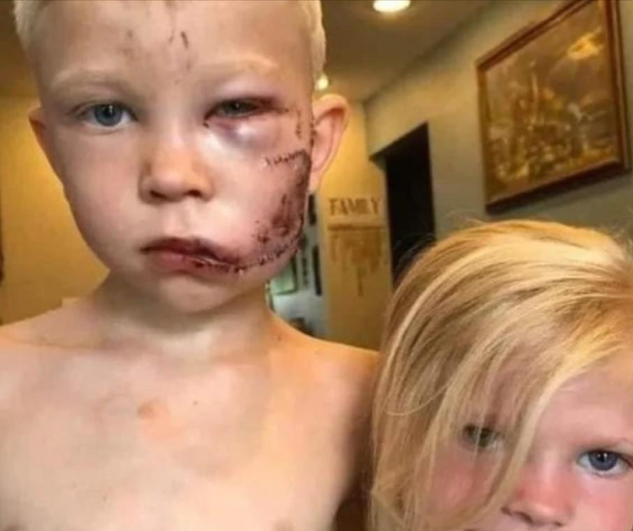 2020年，美国一小男孩从一只牧羊犬口中救出了小妹妹，因此缝了90针，

但把他