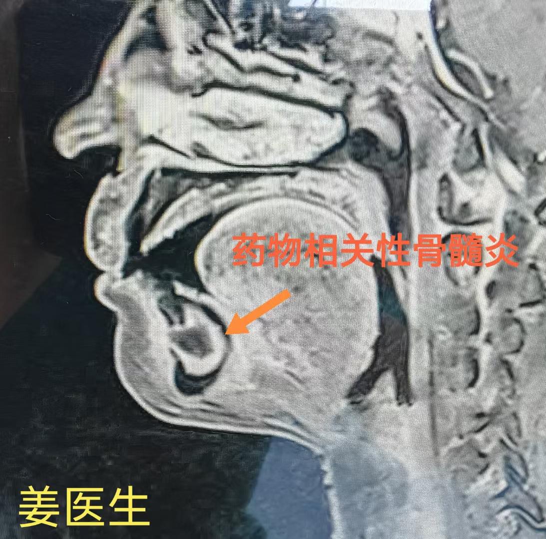 拔牙前需询问患者疾病史、用药史，警惕造成放射或药物相关性骨髓炎！