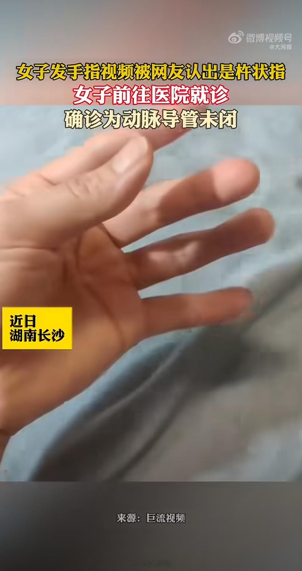 女子晒手指被劝去医院果然查出问题杵状指大多由心肺功能异常引起的，出现这种情况还是