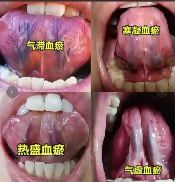 舌下青筋发黑？4种血瘀，你是哪一种？

今天教大家一个简单的法子，不用搭脉，一眼