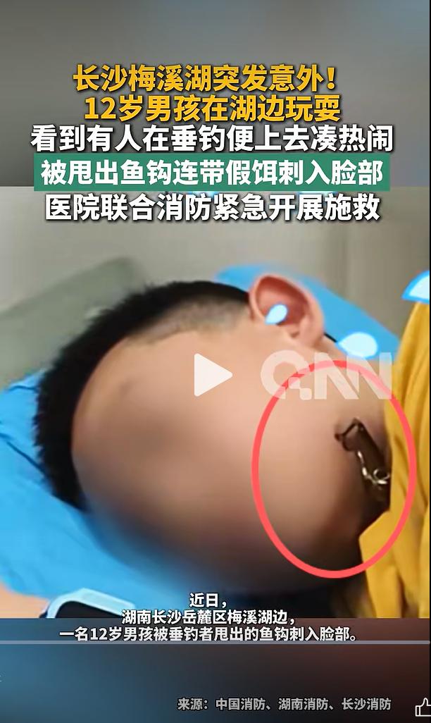 湖南长沙一名 12 岁男孩在湖边游玩，路过垂钓区域时，被钓鱼人士挥竿甩出的鱼钩刺