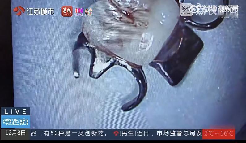 南京一位女士不小心把假牙吞下去了，这可不是小事。
那颗假牙有硬币大小，还带着锋利