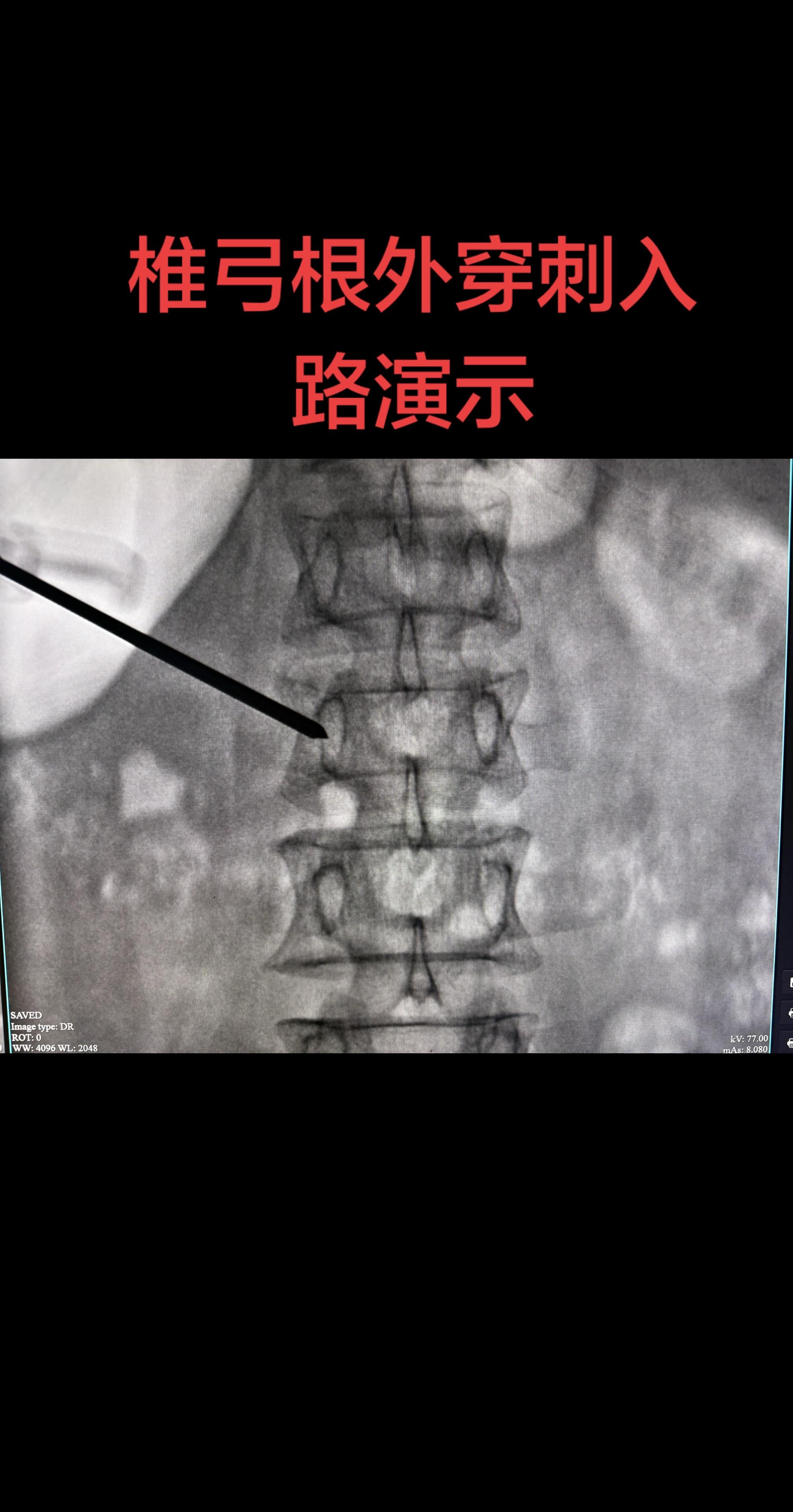 中老年女性的腰椎骨折。56岁体力劳动女性搬个电动车就导致了严重的压缩性...