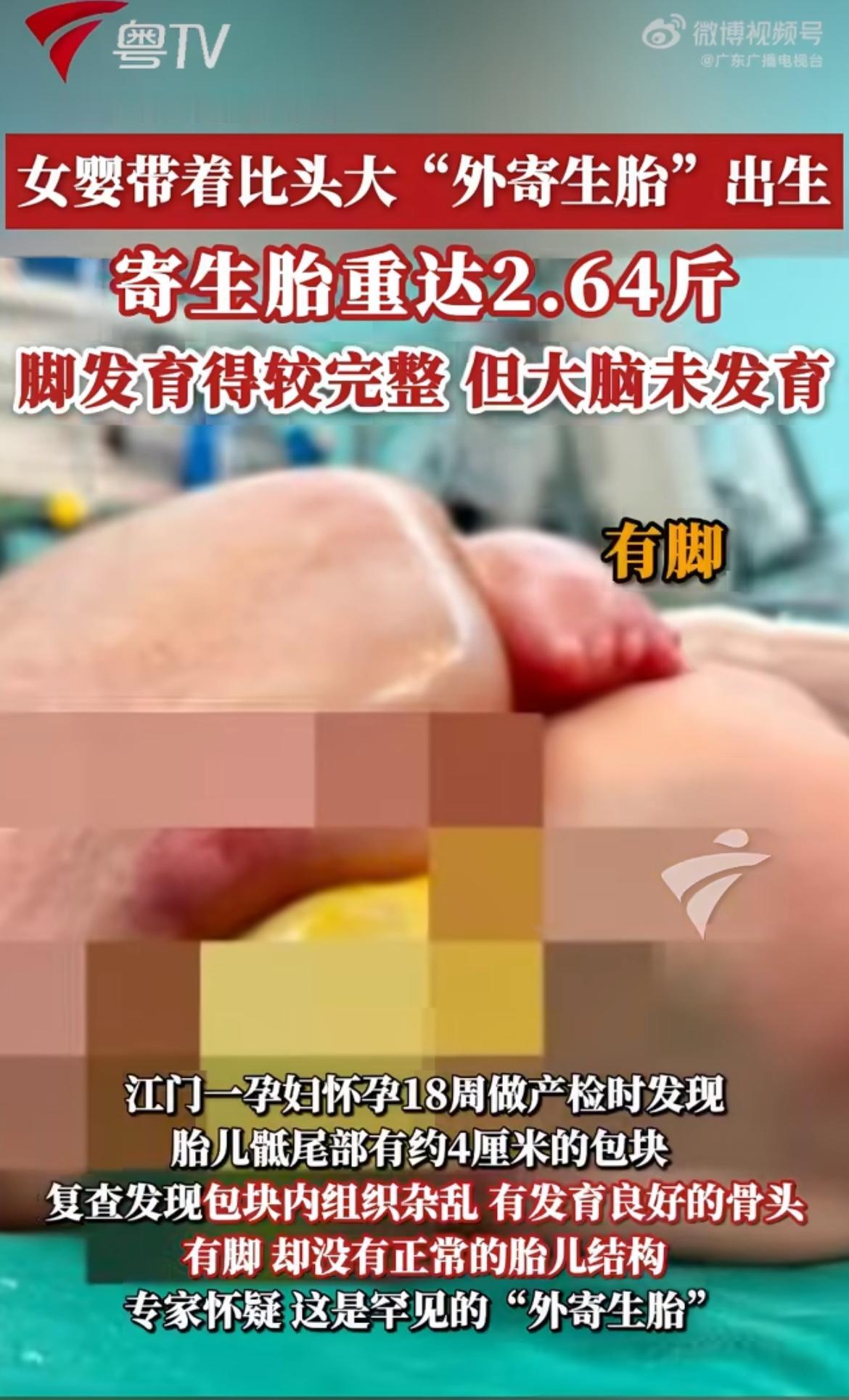 “实属罕见！”广东江门刚出生的小女婴，屁股上挂着比自己脑袋还大的肉球，足足2.6