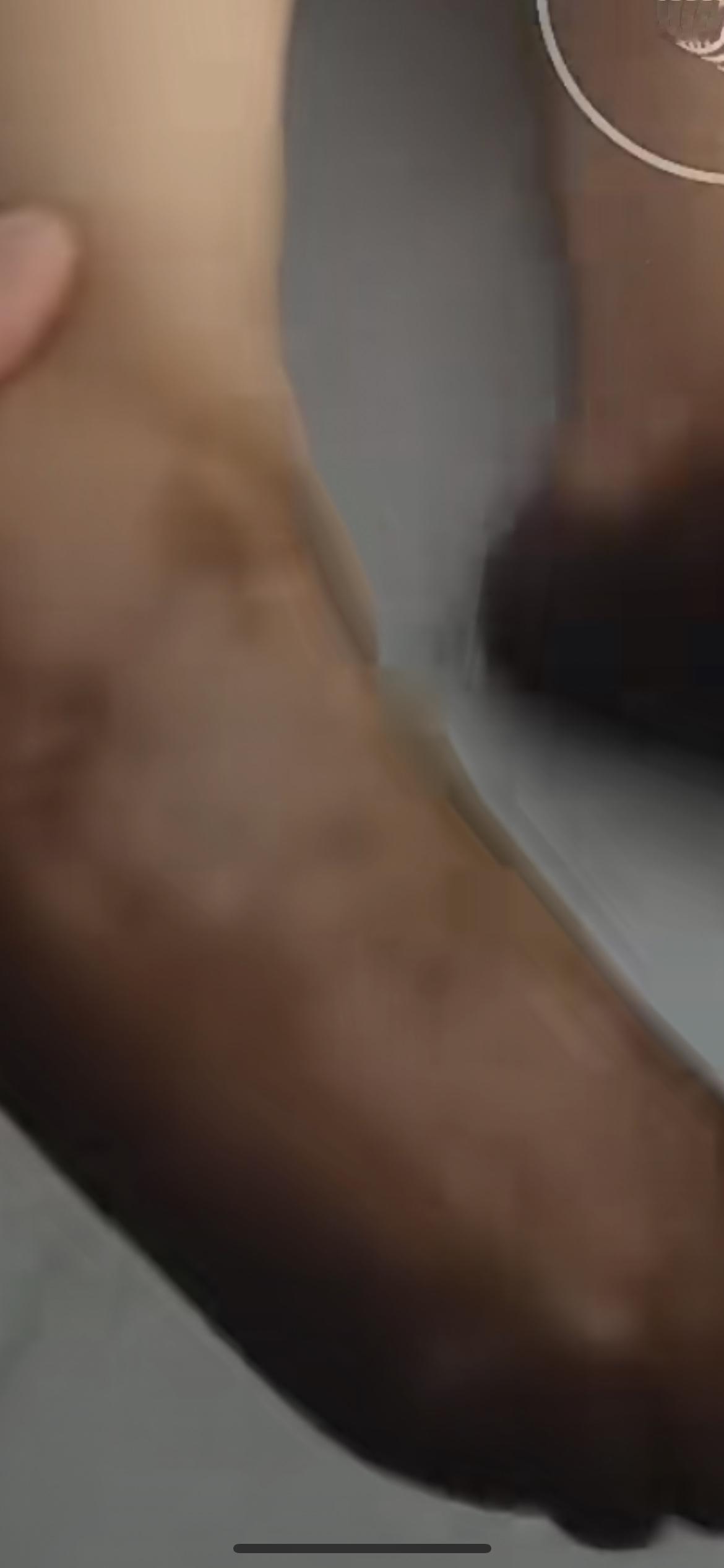 1月1日山东，爸爸本想用高锰酸钾给女儿泡脚杀菌，结果把女儿脚泡成“黑包碳脚”，真