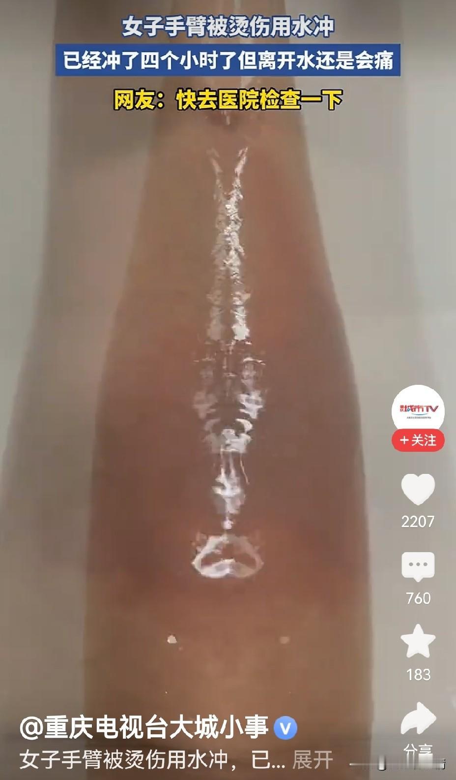 烫伤后，别让“常识”害了你！

山东那位女子，手臂烫伤后用水冲了四个小时，离开水