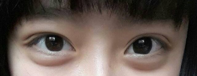 卧蚕大起，人缘无敌；眼下一双肉玉，走哪都是C位。情缘早发，晚景更炽，不论二十青春
