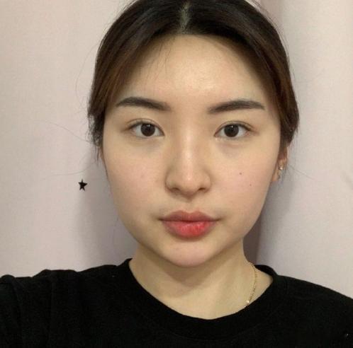 韩国轮廓+鼻子对比案例 